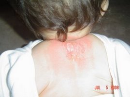 rash1