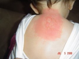 rash3